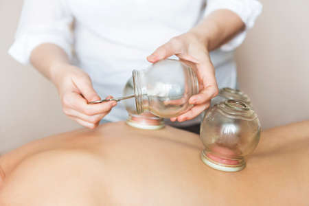 Young woman getting treatment at medical clinic. Fire cupping cups on back of female patient in Acupuncture therapy の写真素材
