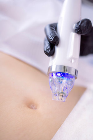 Microneedle RF lifting procedure. Hardware cosmetology. Beautician conducts a body rejuvenation...