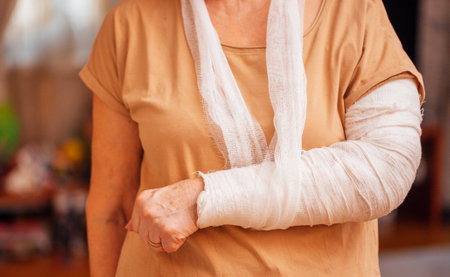 An elderly woman with a cast on her arm in the living room. A mature lady with a bandaged arm. A pensioner in casual clothes with a broken arm at home, close upの写真素材