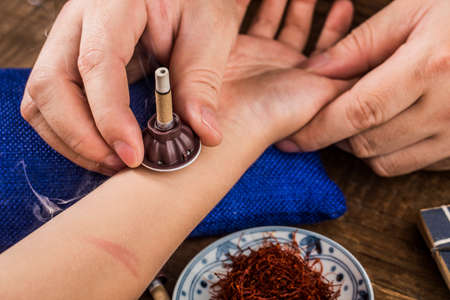 Chinese traditional medicine moxibustion,Moxibustion therapy,の写真素材
