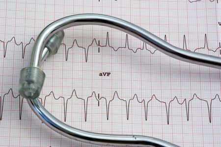 stethoscope sitting a a 12 lead EKG