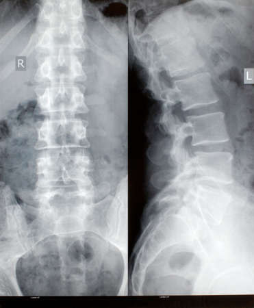 Spine xrayの写真素材