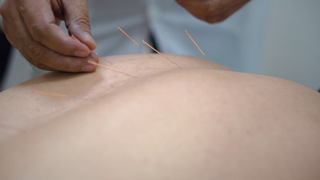 Acupuncture. Close-up of mans back with needles stuck in. Chinese medicine with acupuncture. Man recovers health at professional masseur on Chinese medicineの写真素材