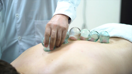 Acupuncture therapist placing a cup on the back of a male patient, ancient Chinese alternative...