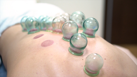 Close up for multiple vacuum cups, medical cupping therapy on human body, wellness, body health concept. Doctor removes cups from the patient back leaving blood marks, Chinese cupping therapy.の写真素材