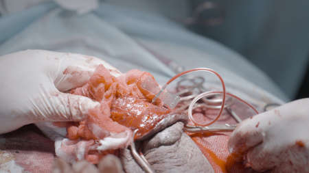 Blood tube in organ. Action. Close-up of surgeons carried out tube with liquid to body. Surgery on male sexual organ. Professional operation with flesh and bloodの写真素材