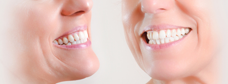 Set of two views of a natural white dentition of a caucasian woman with gold hoop earringsの写真素材