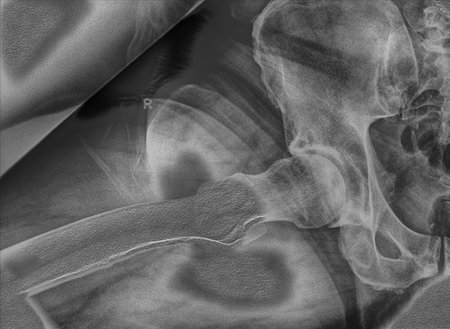 X-ray image of the pelvis and pelvis of a patient.