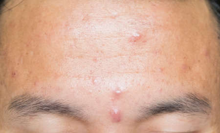 Acne head on the forehead.の写真素材