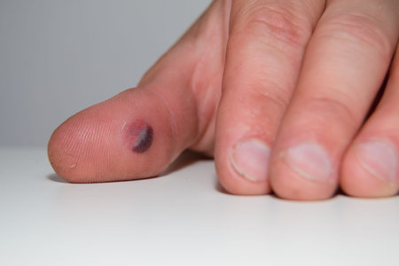 Blood blister under the thumb skin. Caucasian young man finger on white background