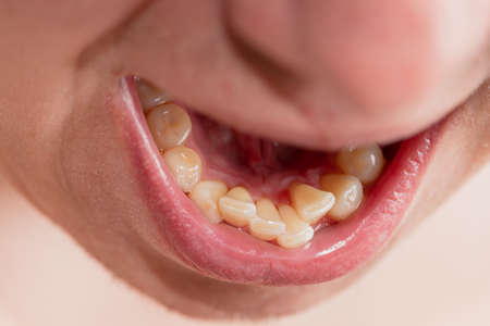 European male open mouth crooked yellow teeth dry lipsの写真素材