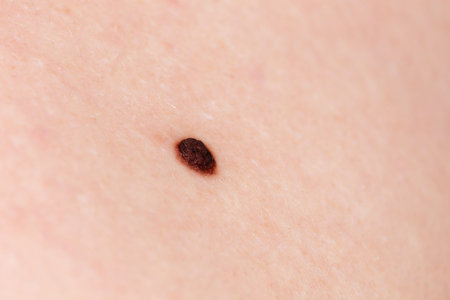 Precancerous mole - dark birthmark is potentially cancerous.