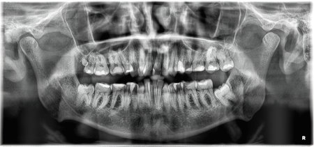 Panoramic Dental X-ray picture - 35 years old male have fourth molar on left side, rare dental...