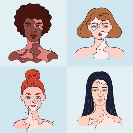 Women faces with vitiligo - vector set. Isolated girls portraits with pigment spots. Collection about diversityのイラスト素材