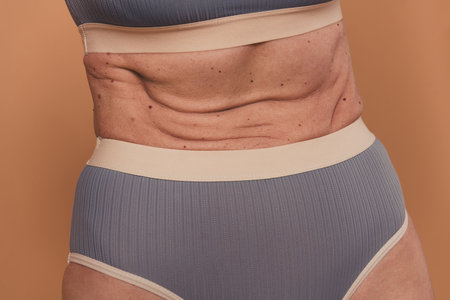 Cropped photo of slim body no filter elderly woman belly with stretch marks isolated on beige color...