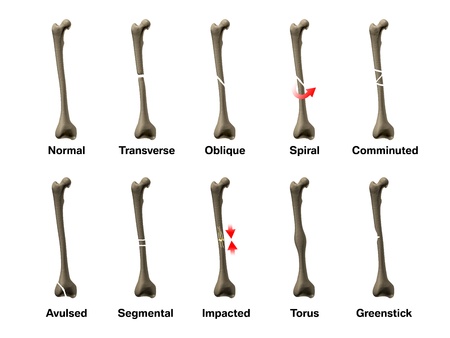 All Types of Bone Fracturesの写真素材
