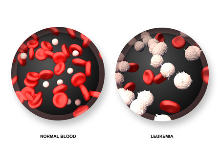 Leukemia vs Normal Bloodの写真素材