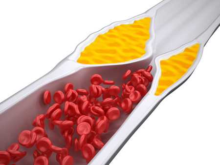 Clogged Artery - Atherosclerosis / Arteriosclerosis - Cholesterol plaque - iso viewの写真素材