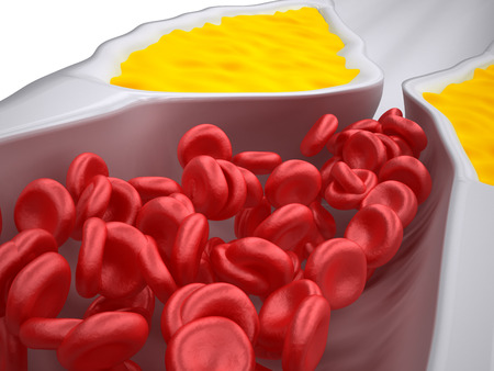 Clogged Artery - Atherosclerosis / Arteriosclerosis - Cholesterol plaque - detailed viewの写真素材