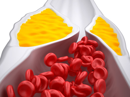 Clogged Artery - Atherosclerosis / Arteriosclerosis - Cholesterol plaque - detailed viewの写真素材