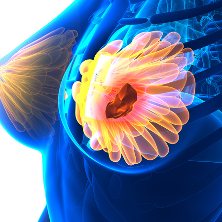 Breast Cancer - Female Anatomy - isolated on whiteの写真素材