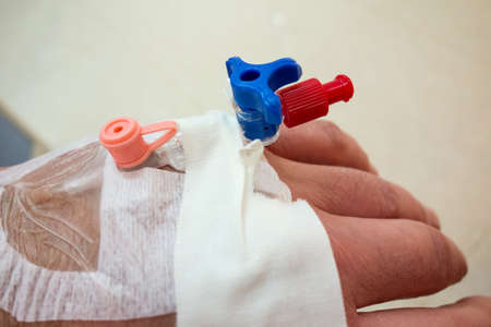 Peripheral venous catheter (venflon) in handの写真素材