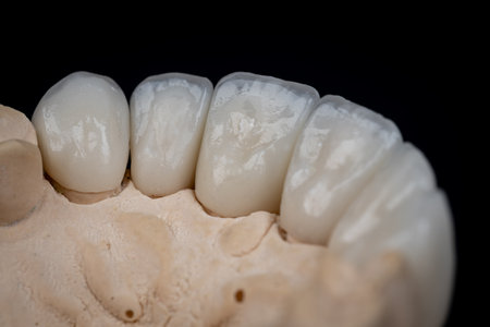 Dental health care. Ceramic zirconium in final version. Close up dental zircon ceramic crowns on black backgroundの写真素材