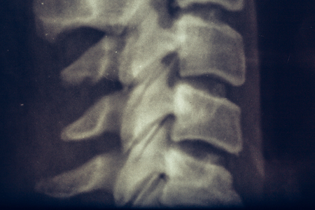 X-ray of human neck, vertebra or spine, close upの写真素材