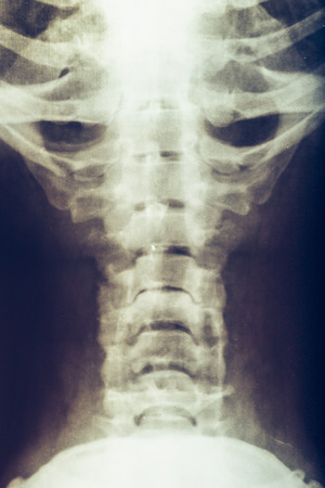 X-ray of human loins or small of the back, vertebra or spine, vertical imageの写真素材