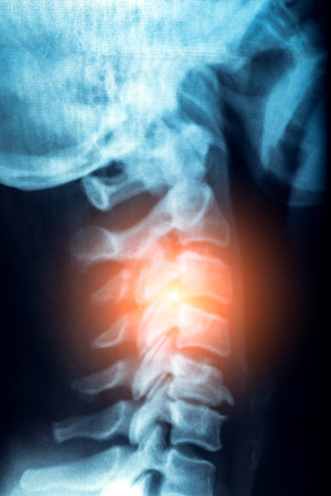X-Ray or MRI of human neck with red zone of pain and stress in spine or vertebrae, trauma and rheumatism concept.の写真素材