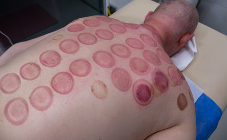 Red traces on male skin after treatment by Vacuum Cupping close up. Ancient alternative Chinese...
