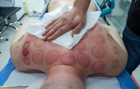 Red traces on male skin after treatment by Vacuum Cupping close up. Ancient alternative Chinese...