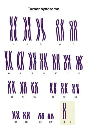 Human karyotype of Turner syndrome. One of the X chromosomes (sex chromosomes) is missing or partially missing. 45,X, or 45,X0のイラスト素材