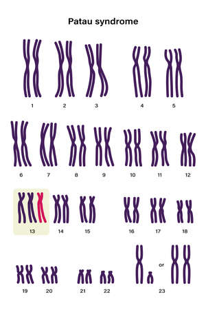 Human karyotype of Patau syndrome. Autosomal abnormalities. Patau syndrome have an extra copy of one of these chromosomes, chromosome 13. Trisomy 13, Genetic disorder.のイラスト素材
