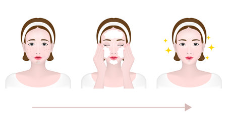Portrait of a woman before, during and after cleansing the facial skin, Blackhead, Whitehead, Papule, Pustule, Skin problems.のイラスト素材