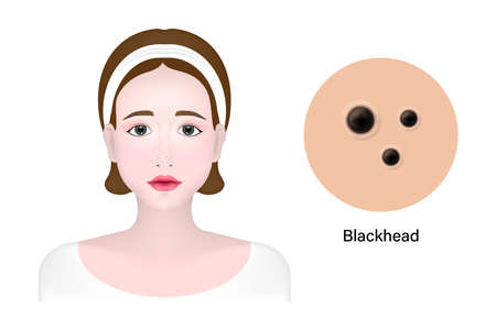 Women and blackhead acne, Skin problem vectorのイラスト素材