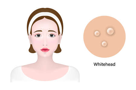 Women and whitehead acne, Skin problem vectorのイラスト素材