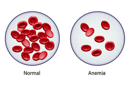 Diagram of comparison between normal red blood cells and anemia.のイラスト素材
