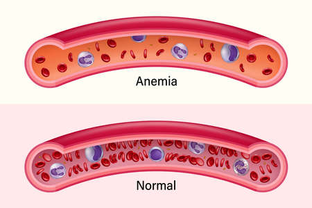 Comparison between normal red blood cells and anemia.のイラスト素材