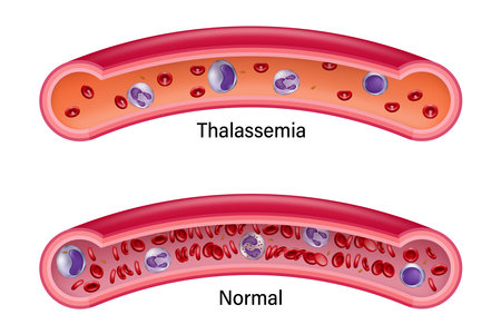 Comparison between normal red blood cells and thalassemia. Medical education.のイラスト素材