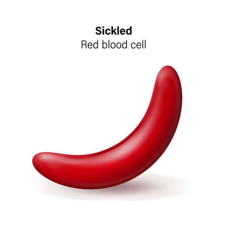 Sickle cell disease. Sickled red blood cells vector.のイラスト素材