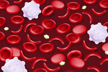 Blood of sickle cell disease. sickled red blood cells.