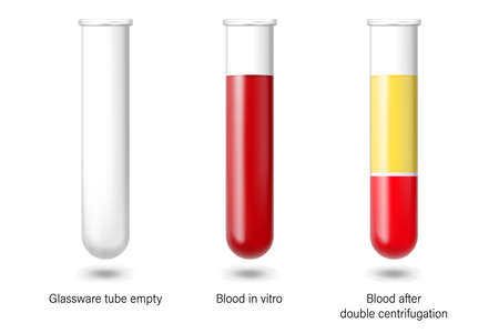 Glassware tube empty, blood in vitro and blood after double centrifugation. Medical laboratory.のイラスト素材