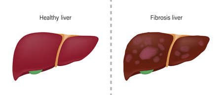 Comparison of the difference between normal liver and fibrosis. Liver disease for medical education and science.のイラスト素材