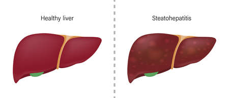 Comparison of the difference between normal liver and steatohepatitis. Liver disease for medical education and science.のイラスト素材
