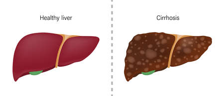 Comparison of the difference between normal liver and cirrhosis. Liver disease for medical education and science.のイラスト素材