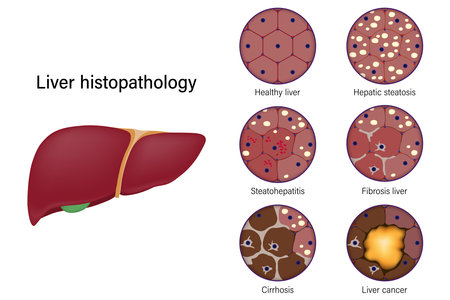 Liver histopathology. Healthy liver, Hepatic steatosis, Steatohepatitis, Fibrosis liver, Cirrhosis and Liver cancer.のイラスト素材