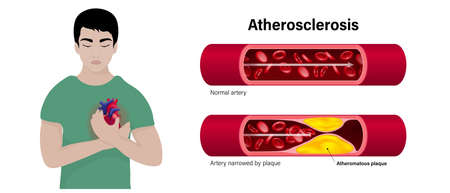Atherosclerosis vector concept. The difference of normal artery and Artery narrowed by plaque....