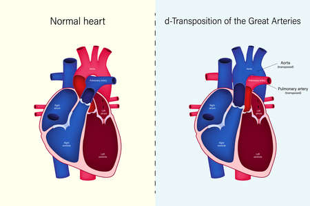 The difference of Normal heart and d-Transposition of the Great Arteries vector. Congenital heart disease.のイラスト素材