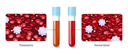 The difference of Thalassemia and Normal blood. Thalassemia disease.のイラスト素材